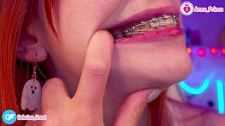 SFW Braces Elastics Close-Up