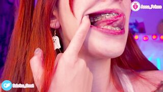 SFW Braces Elastics Close-Up