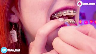 SFW Braces Elastics Close-Up