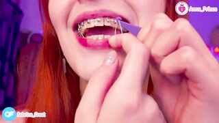 SFW Braces Elastics Close-Up