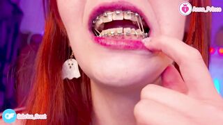 SFW Braces Elastics Close-Up
