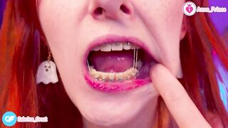 SFW Braces Elastics Close-Up